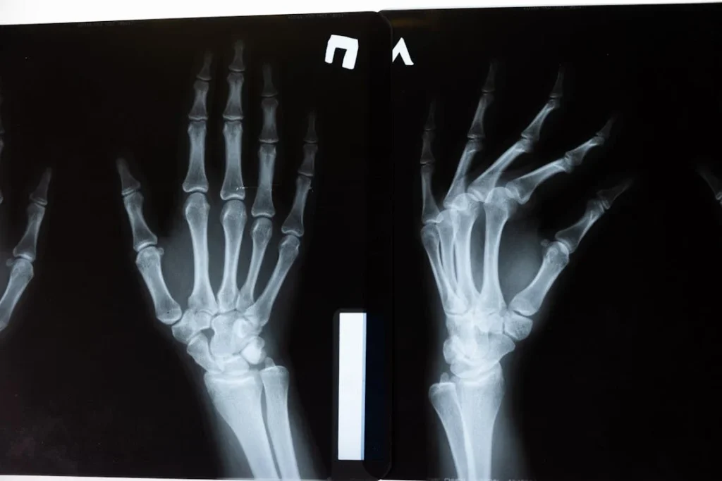 Bone health is important for everyone, but for amputees, it becomes even more critical. When a limb is lost, the body undergoes major changes. The remaining bones have to bear extra weight and pressure, which can make them wear down faster. Over time, this can lead to conditions like osteoporosis, fractures, and joint problems. Understanding why this happens is the first step toward protecting your bones and maintaining a healthy, active lifestyle.