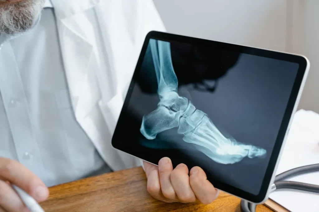 Neglecting bone health can lead to serious long-term consequences for amputees. Since their bodies undergo extra strain due to the loss of a limb, weak bones can make mobility more difficult and even painful. The most common issues include osteoporosis, stress fractures, joint pain, and difficulty using prosthetics effectively. These complications can interfere with daily life, making simple activities such as walking, standing, or even using assistive devices much harder.